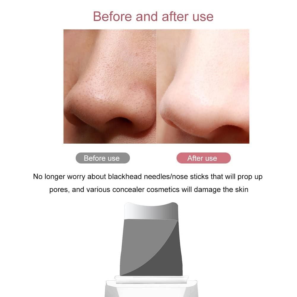 Ultrasonic Facial Kit White Heads And Blackhead Remover Removal Tool yzatrg-dh